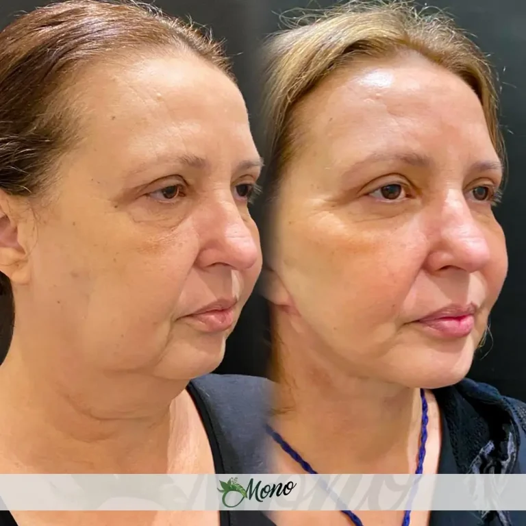 Facial Rejuvenation Turkey