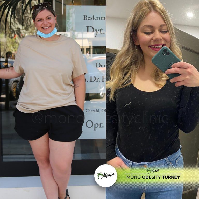 Gastric Sleeve