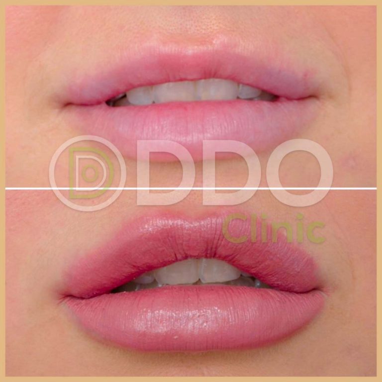 Dermal Fillers Turkey
