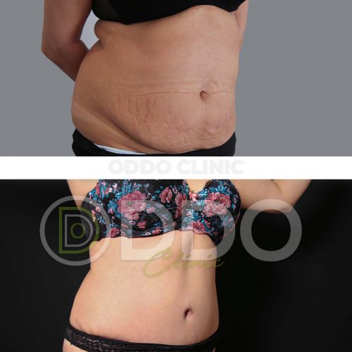 Tummy Tuck Turkey